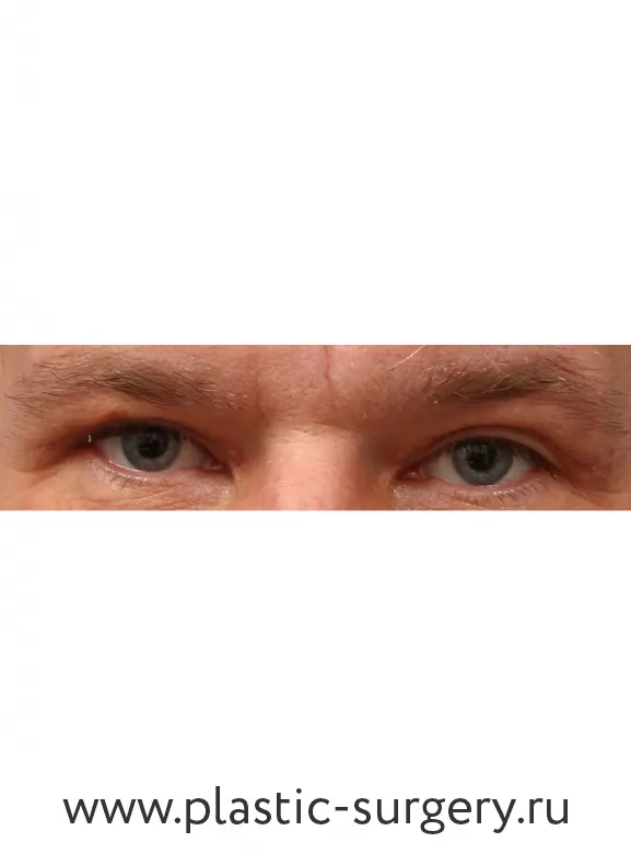 Пластика верхних век - После