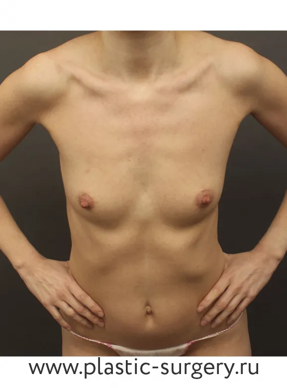 Пластика анатомическими имплантами - До