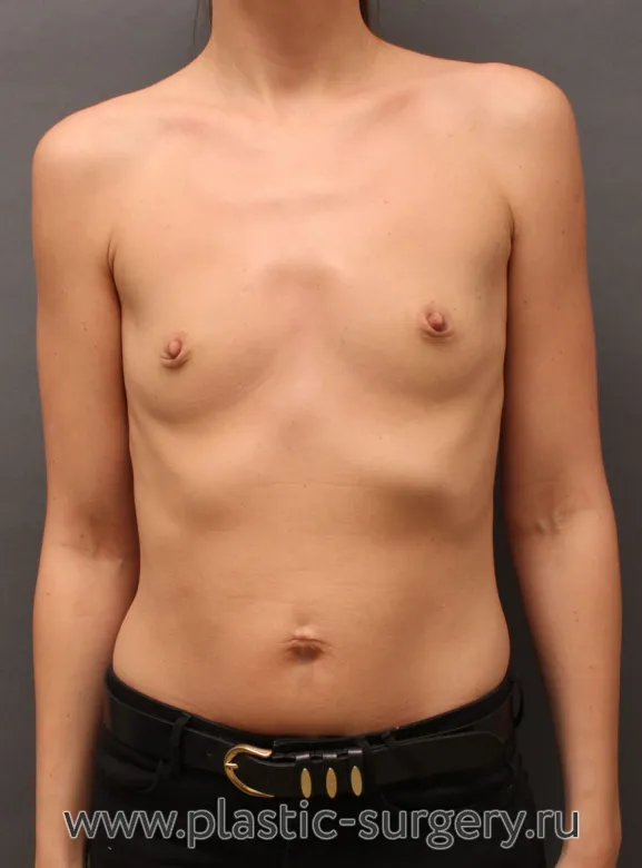 Полиуретановые импланты - До