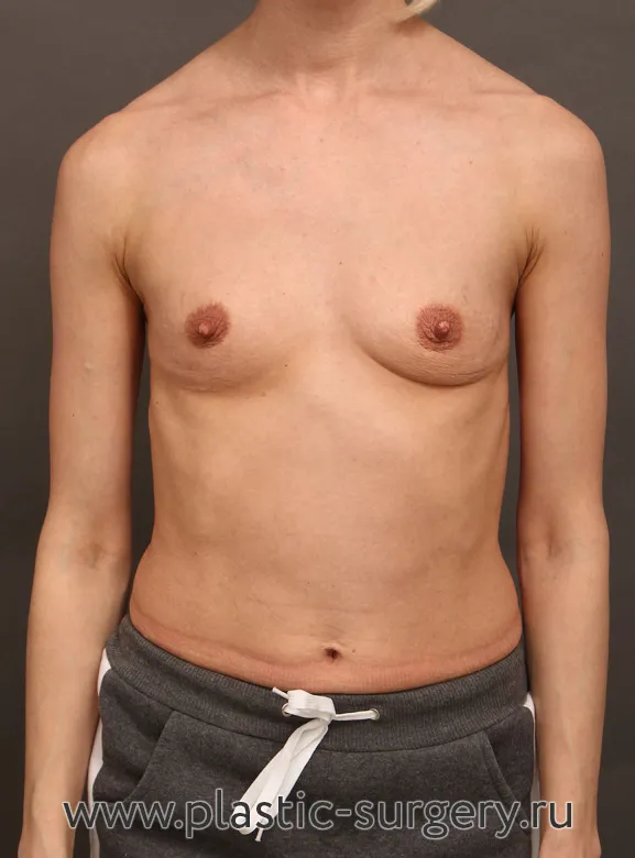 Текстурированные анатомические импланты. На фото - результат через месяц после операции. - До