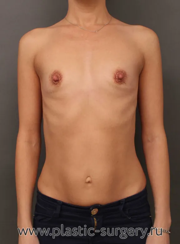 Фото результата пластической операции - До