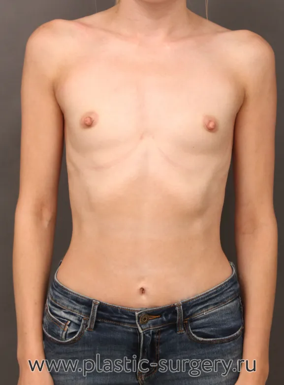 Увеличение молочных желез - До