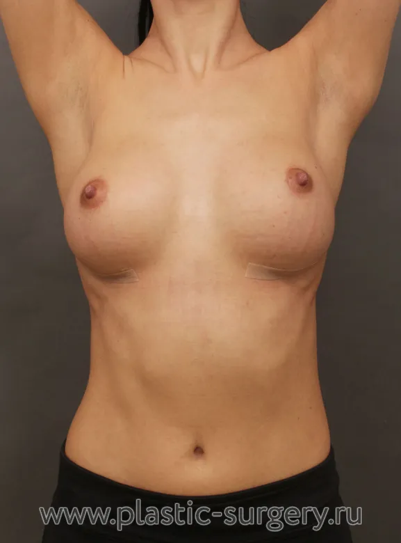 Анатомические импланты - После