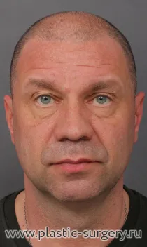 Фронтально-темпоральный лифтинг, лобно-височный эндолифтинг, пластика нижних век, липофилинг. На фото - результат через месяц после операции.