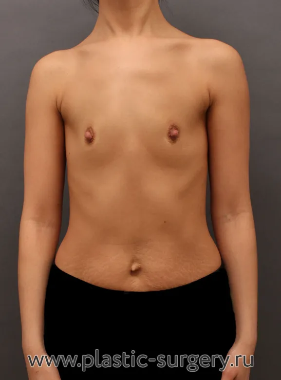 Операция с использованием анатомических имплантов - До