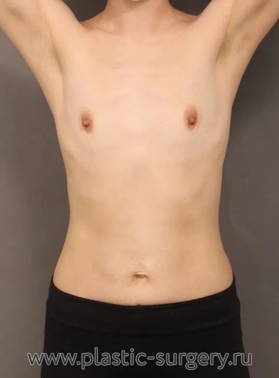 Увеличение груди через подмышку. Трансаксиллярный доступ - До