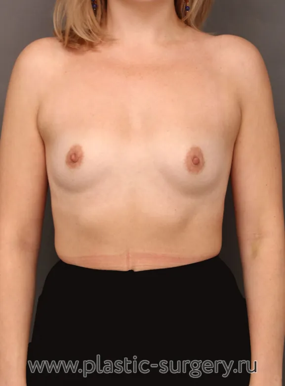 Увеличение молочных желез - До