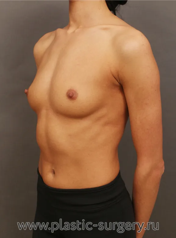 Анатомические импланты - До