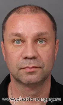 Фронтально-темпоральный лифтинг, лобно-височный эндолифтинг, пластика нижних век, липофилинг. На фото - результат через месяц после операции.