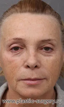 Эндоскопический лобно-височный лифтинг, smas-подтяжка (лифтинг) нижней трети лица и шеи, медиальная и латеральная платизмопластика, коррекция высоты верхней губы (булхорн).