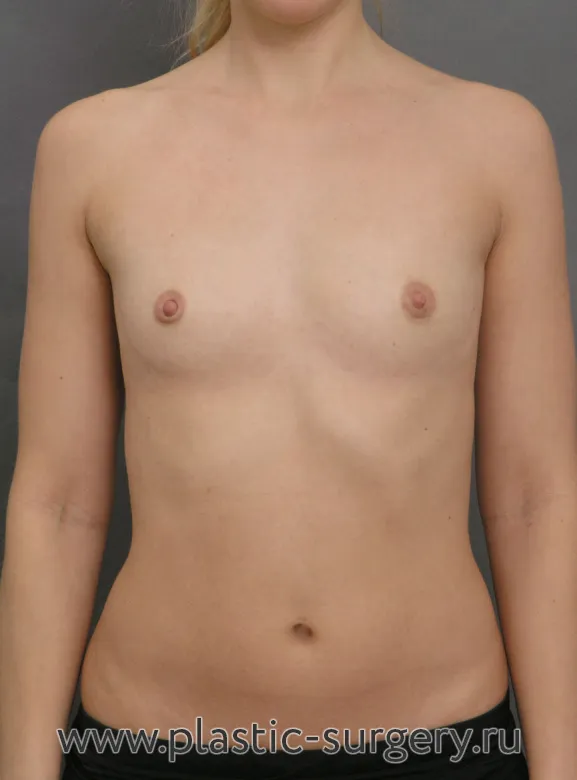 Увеличение маленькой груди - До