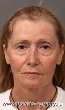 Стандартный открытый лифтинг лица и шеи, пластика верхних и нижних век, липофиллинг области носогубных складок, углов рта, красной каймы верхней губы, бровей, коррекция высоты верхней губы.