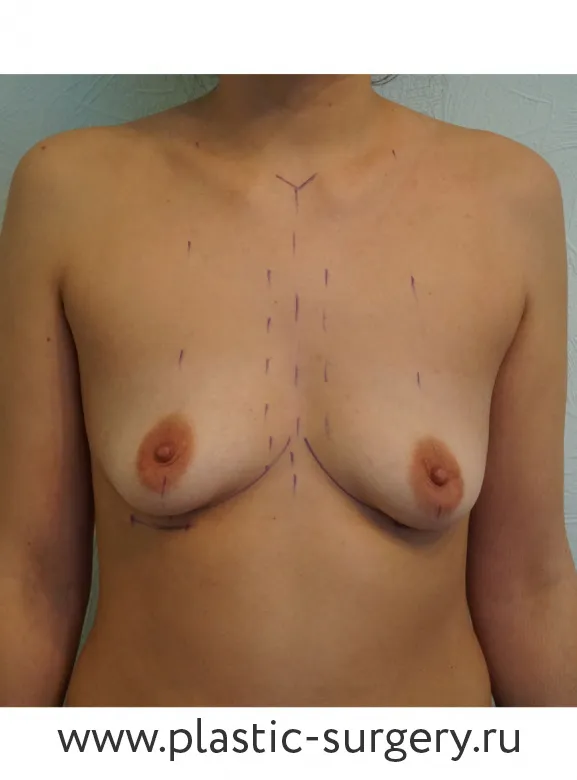 Увеличение молочных желез - До