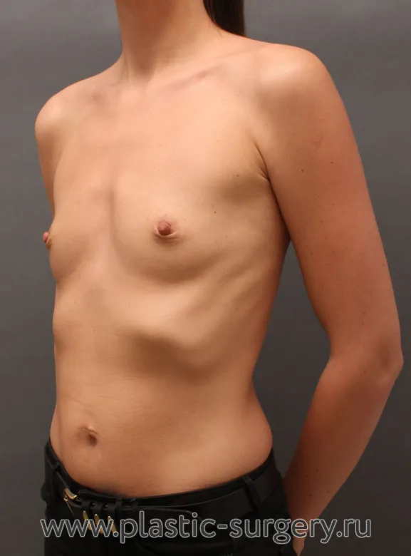 Полиуретановые импланты - До