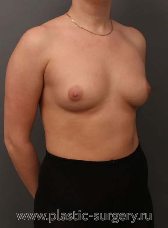 Пластика круглыми имплантами - До