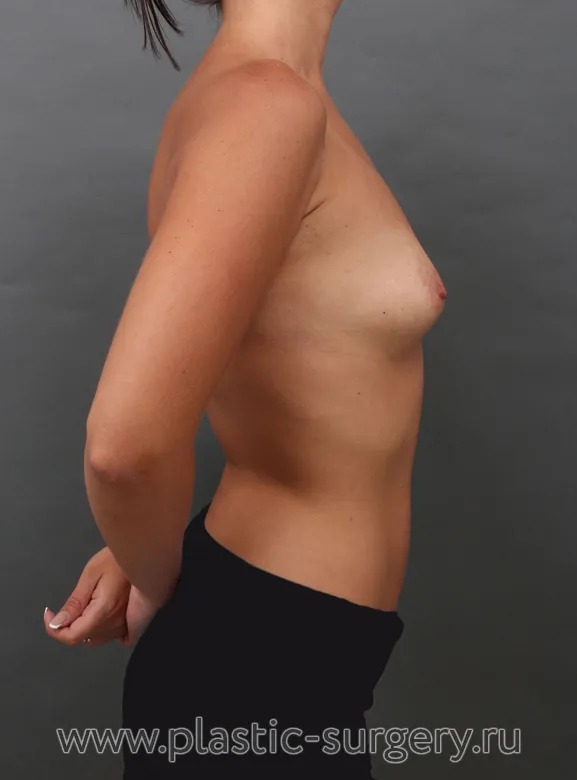 Полиуретановые импланты - До