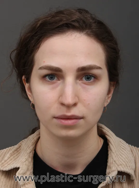 Эндоскопический лифтинг фронтально-темпоральный (лобно-височный), риносептопластика. Результат через полгода после операции - До