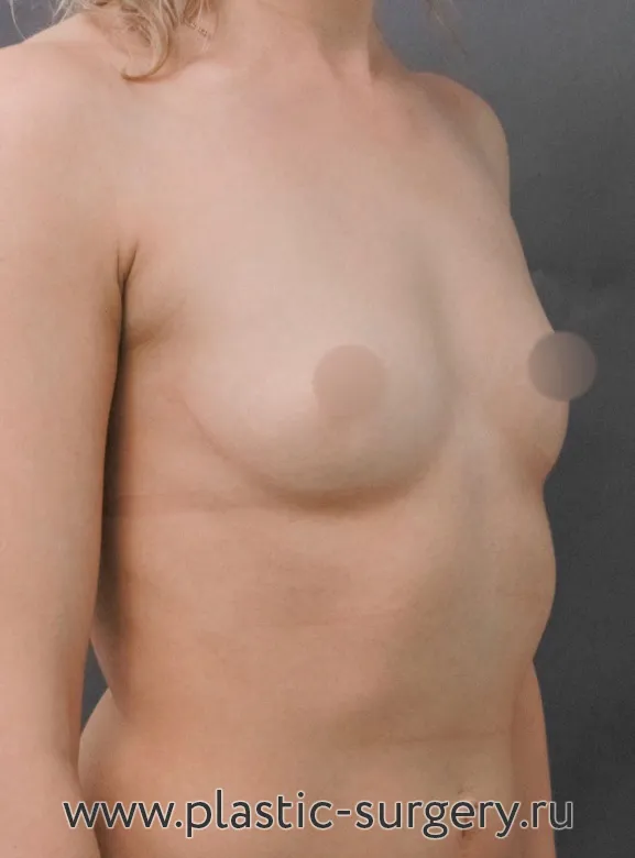 Увеличение маленькой груди - До
