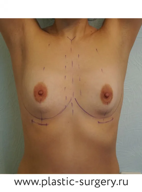 Увеличение молочных желез - До