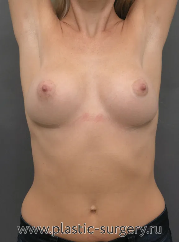 Анатомические импланты - После