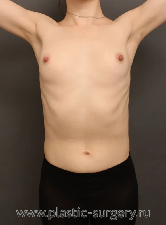 Пластика с применением круглых имплантов - До