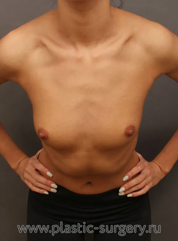 Анатомические импланты - До