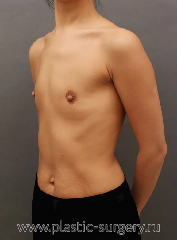 Операция с использованием анатомических имплантов - До