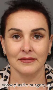 Эндоскопия лба, SMAS лица и шеи, пластика нижних век, медиальная платизмопластика, липосакция подбородка, булхорн, липофилинг бровей, мочки уха 