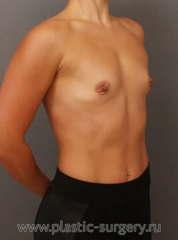 Результат пластической операции - До