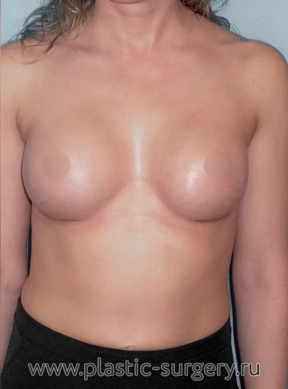 Увеличение маленькой груди - После