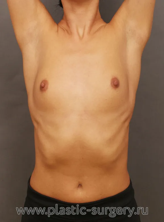 Анатомические импланты - До