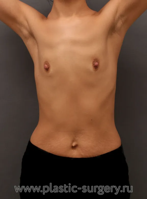 Операция с использованием анатомических имплантов - До