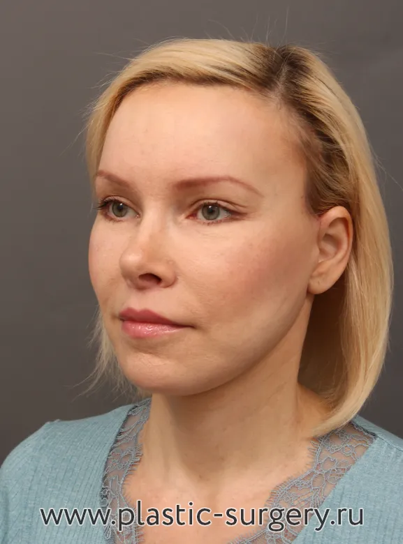 Комплексное омоложение и бьютификация лица и шеи: риносептоластика, увеличение подбородка, липофиллинг  бровей, эндоскопический лифтинг лба и височных областей, нижняя пластика век "пинч" методом, булхорн, СМАС(SMAS)-лифтинг нижней трети лица и шеи - После