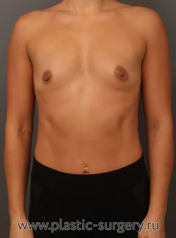 Результат пластической операции - До