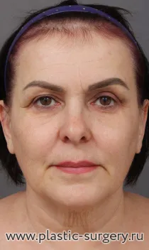 Эндоскопия лба, SMAS лица и шеи, пластика нижних век, медиальная платизмопластика, липосакция подбородка, булхорн, липофилинг бровей, мочки уха 