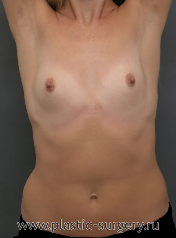 Анатомические импланты - До