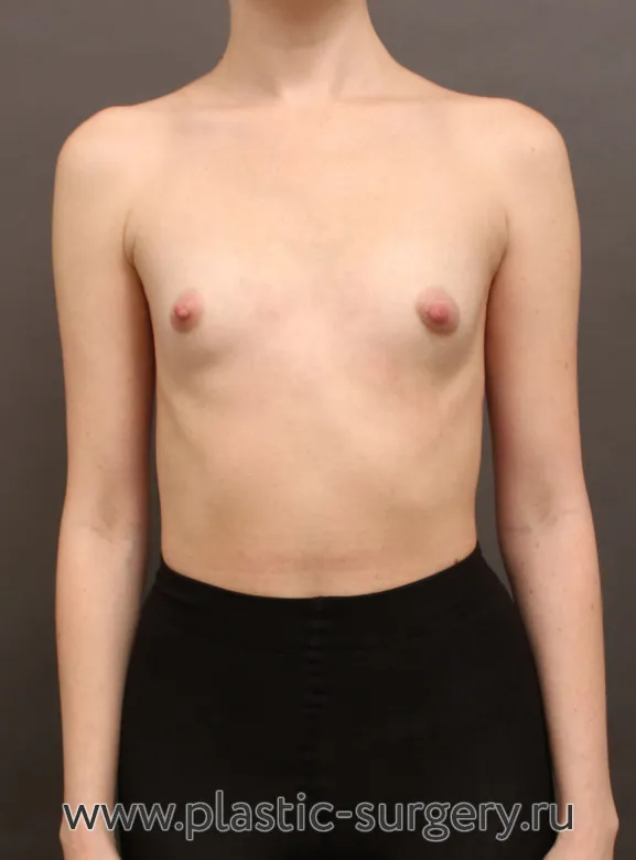 Увеличение груди до 3-го размера. На фото - результат через 3 месяца после операции. - До