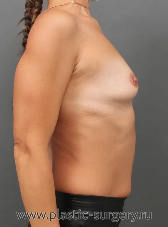 Текстурированные анатомические импланты - До