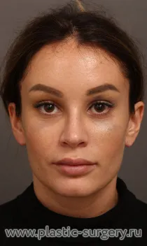 Эндоскопический лифтинг тканей лба и височных областей. Результат - через 1 месяц после операции.