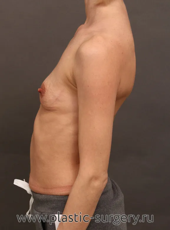 Текстурированные анатомические импланты. На фото - результат через месяц после операции. - До