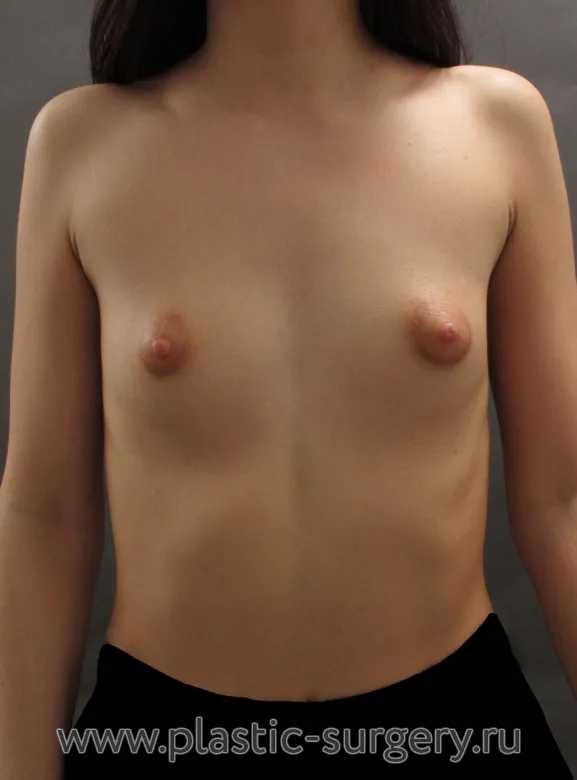 Увеличение молочных желез - До