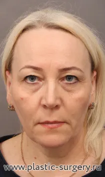 Омоложение лица и шеи: SMAS лифтинг лица и шеи, эндоскопический фронто-темпоральный лифтинг, верхняя и нижняя блефаропластика, медиальная платизмопластика, булхорн, липофилинг верхней и нижней губы. Результат на фото - через год после операции.