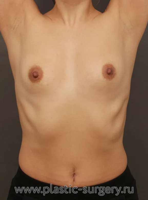 Круглые импланты - До