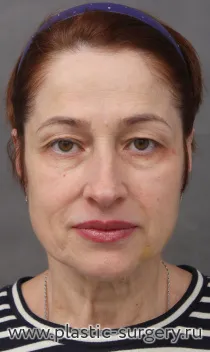 Эндоскопический лобно-височный лифтинг, открытый лифтинг лица и шеи, верхняя блефаропластика, "пинч" нижних век. Результат на фото - через 7 месяцев после операции.