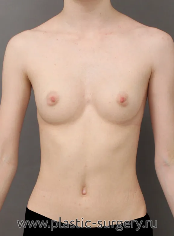 Увеличение груди полиуретановыми имплантами - До