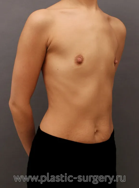 Операция с использованием анатомических имплантов - До