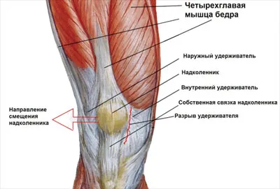 Вывих надколенника